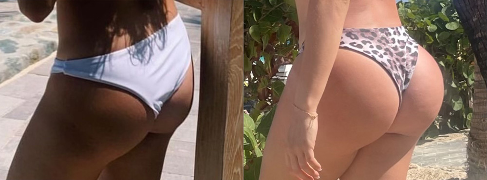 Brazilian Butt Lift Before and After