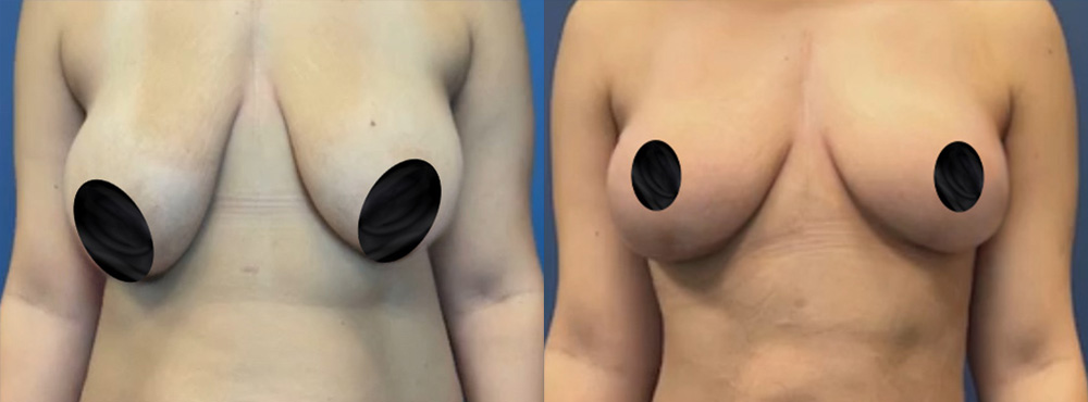 Breast Lift before and after
