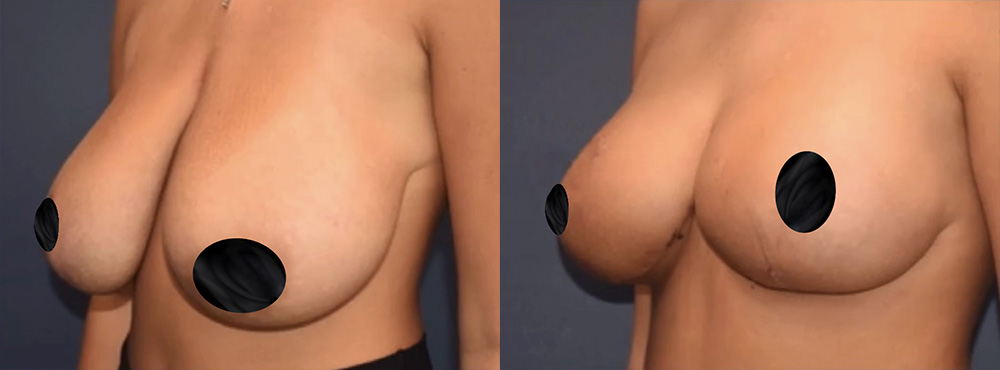 Breast Reduction Before and After