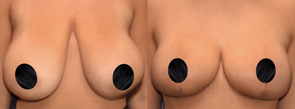Breast Reduction Before and After