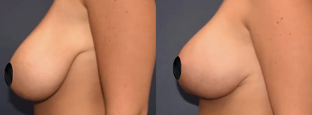 Breast Reduction Before and After