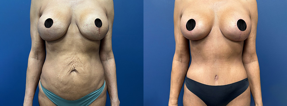 Mommy Makeover Before And After