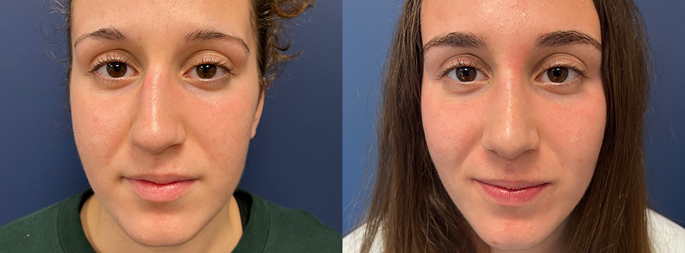 Rhinoplasty Before and After