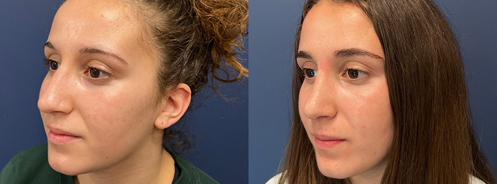 Rhinoplasty Before and After