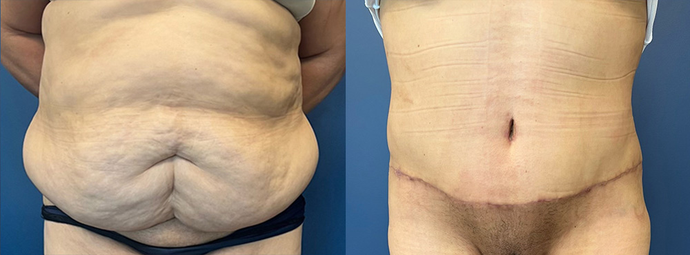 Tummy Tuck Before and After in Miami