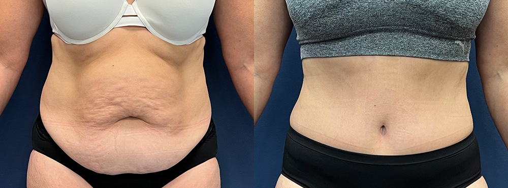 Tummy Tuck Before And After