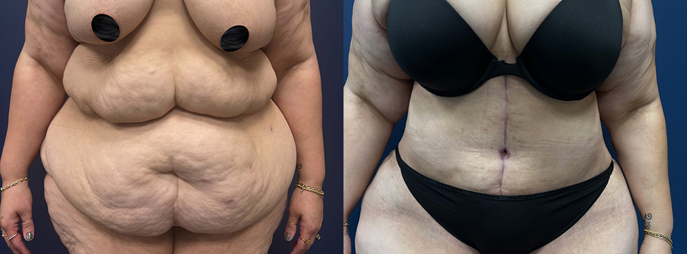 Tummy Tuck Before and After