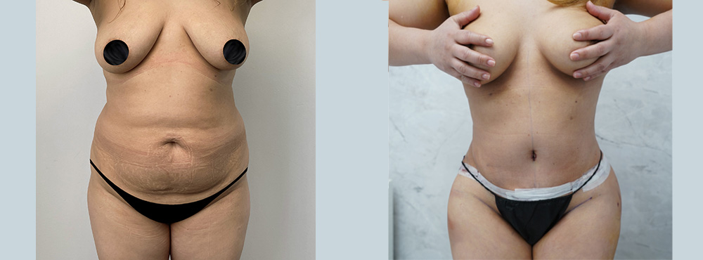 Mommy Makeover Before And After in Miami