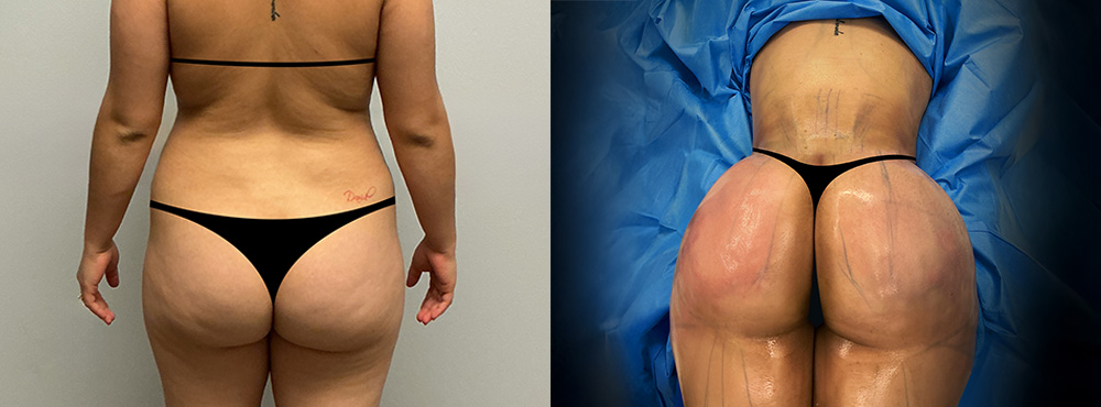 Brazilian Butt Lift Before and After