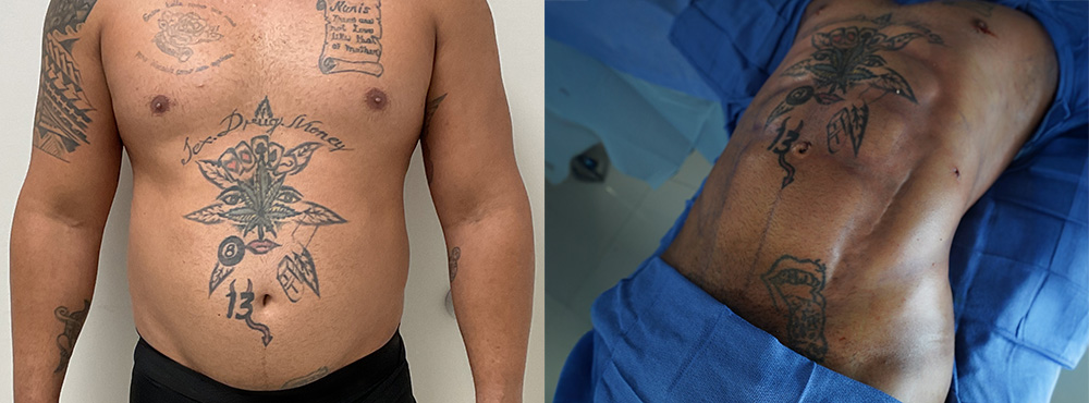 Abdominal Etching before and after in miami