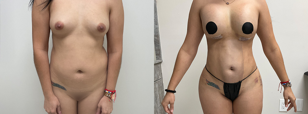 Butt Lift Before and After