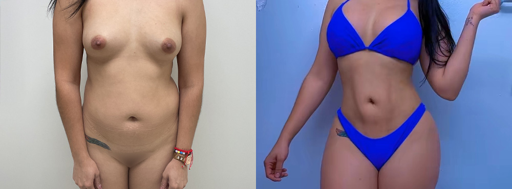 Butt Lift Before and After