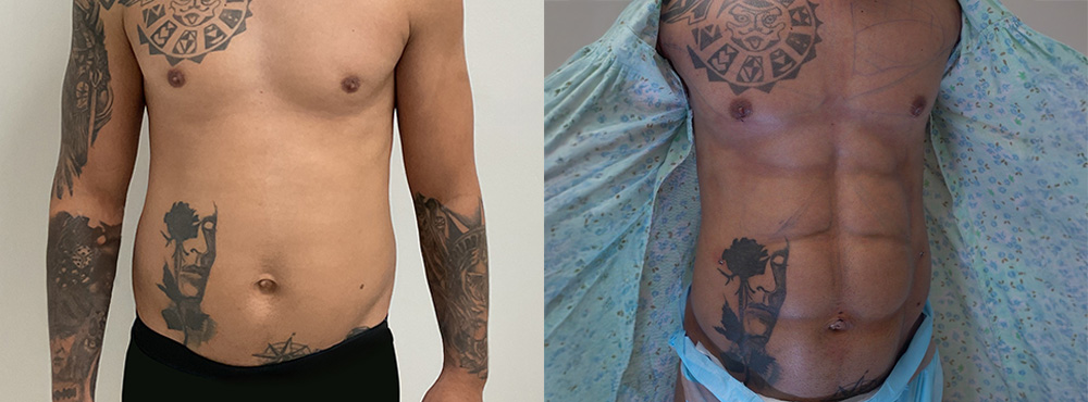 Abdominal Etching Before and After in Miami