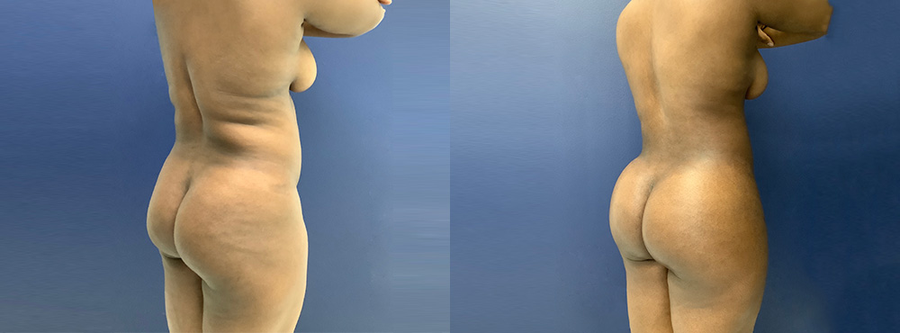 BBL Before and After