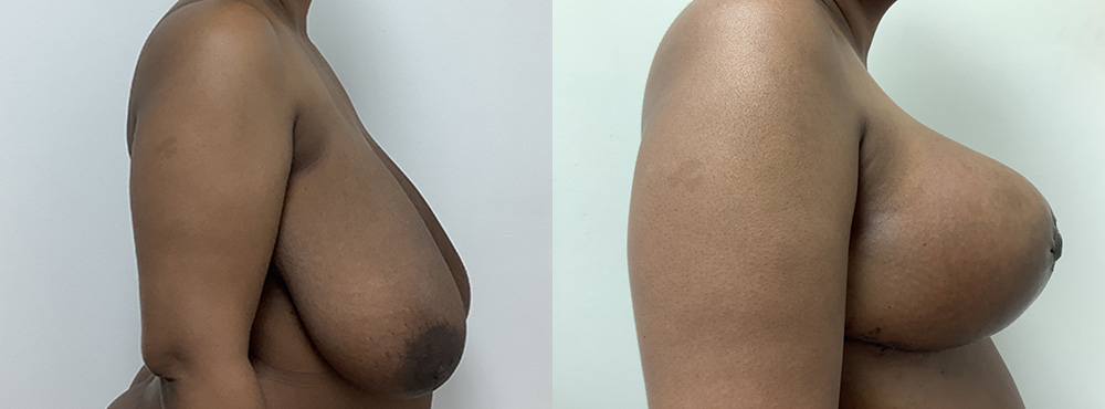 Breast Reduction Before and After