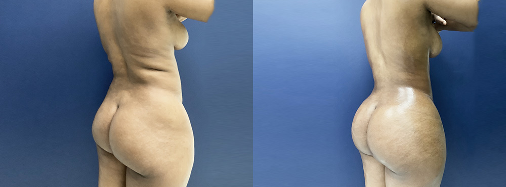 BBL Before and After