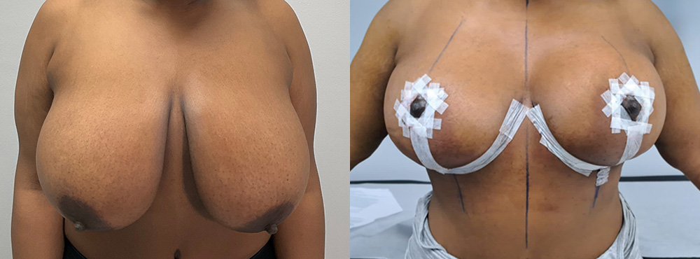 Breast Reduction Before and After