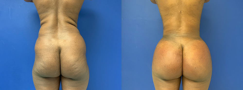 Brazilian Butt Lift Before and After