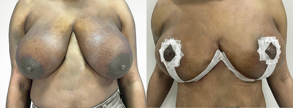 Breast Reduction Before and After
