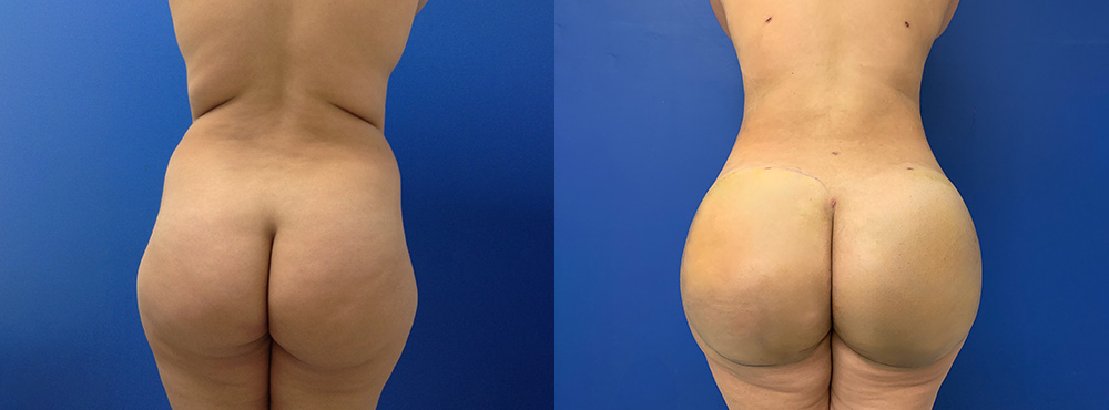 Brazilian Butt Lift Before and After 