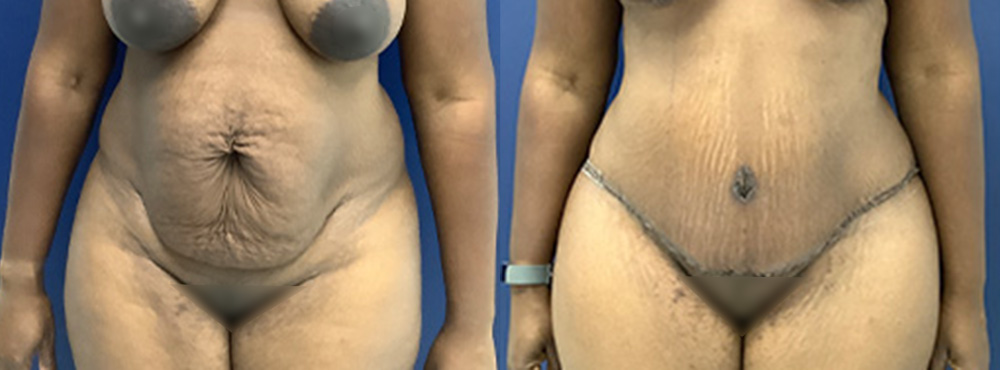 Tummy Tuck Before and After
