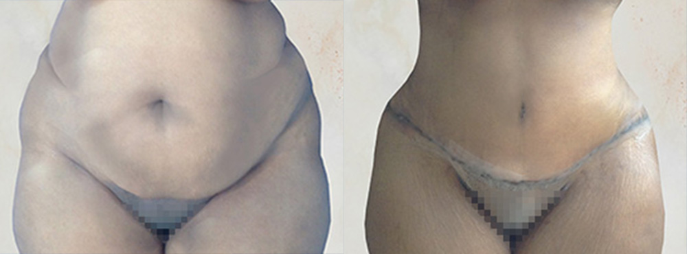 Tummy Tuck Before and After