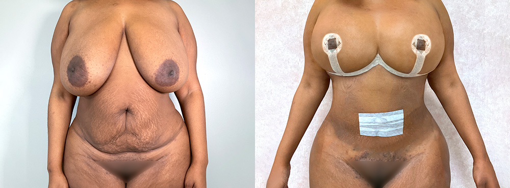 Mommy Makeover Before and After