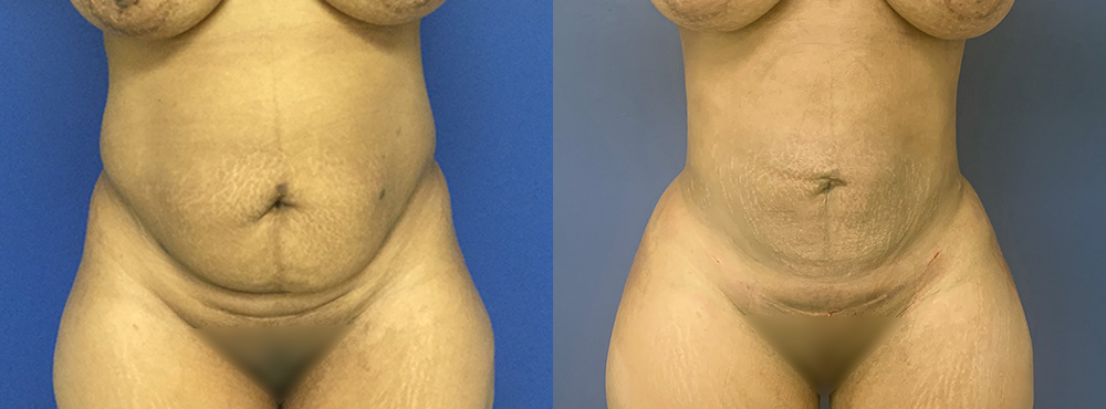 Brazilian Butt Lift Before and After