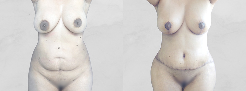 Mommy Makeover Before and After