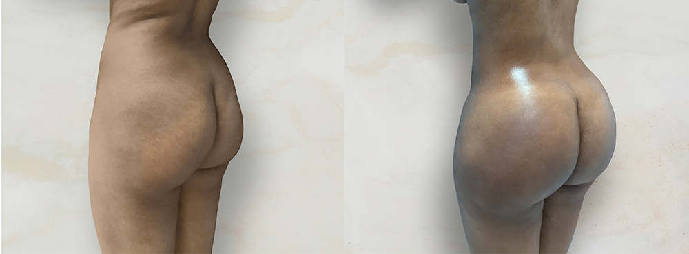 BBL Before and After