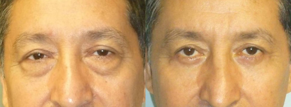 Blepharoplasty Before and After