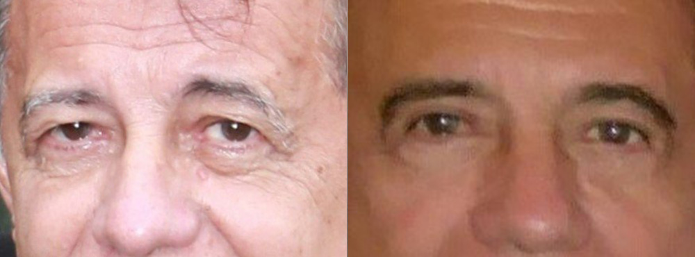 Blepharoplasty Before and After