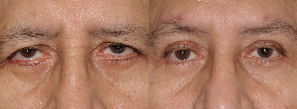 Eyelid Surgery in Miami Before And After