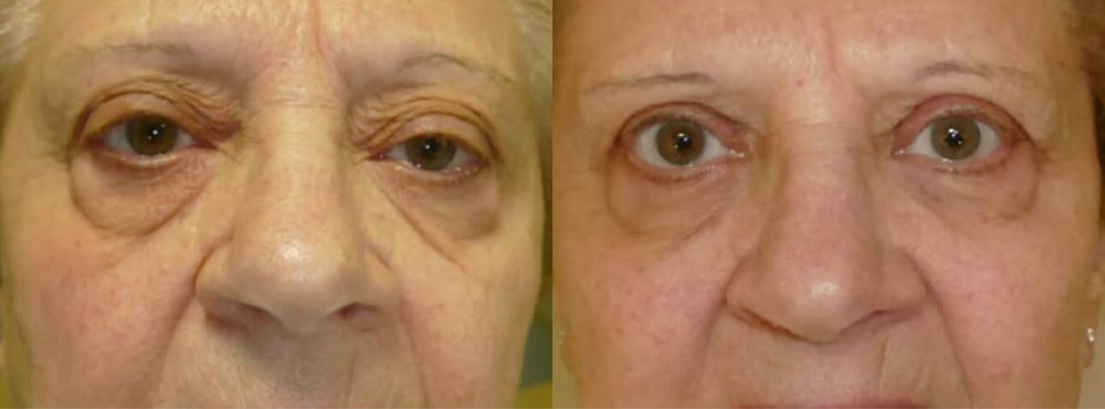 Eyelid Surgery in Miami Before And After