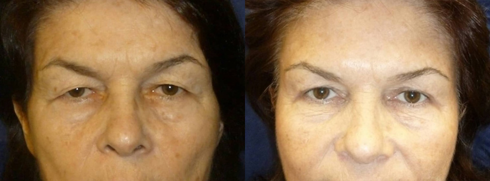 Blepharoplasty Before and After