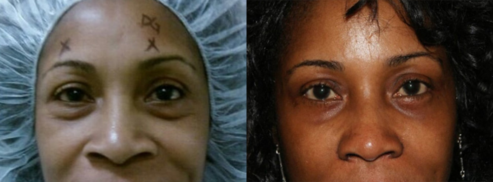 Blepharoplasty Before and After