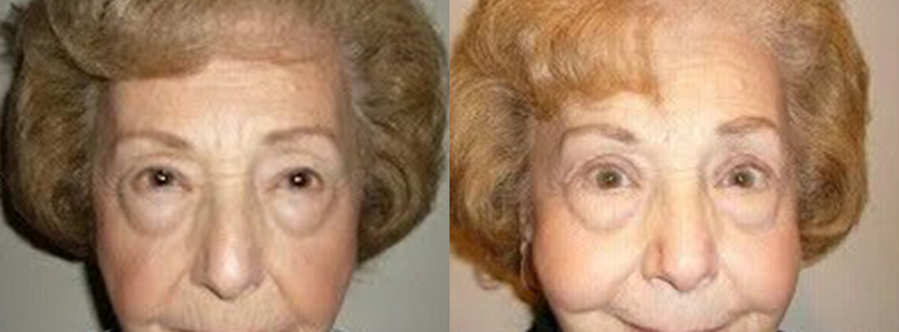Blepharoplasty Before and After
