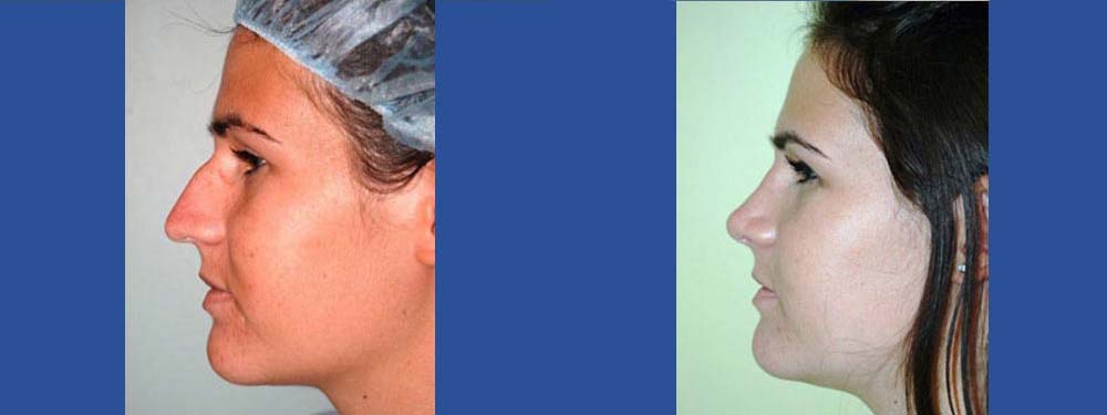 Rhinoplasty before and after