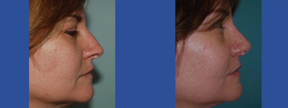 Rhinoplasty before and after in miami