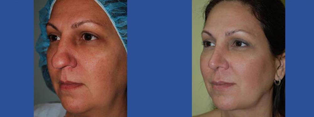 Rhinoplasty Before and After in Miami