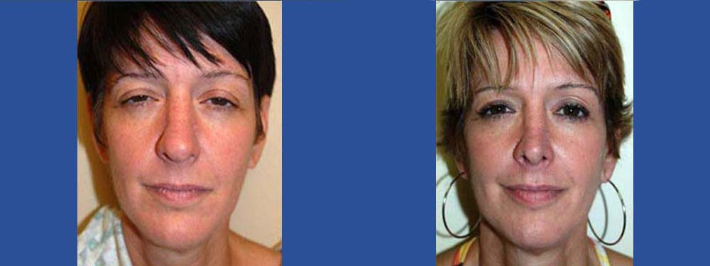 Rhinoplasty before and after in miami
