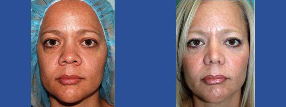 Rhinoplasty Before and After in Miami