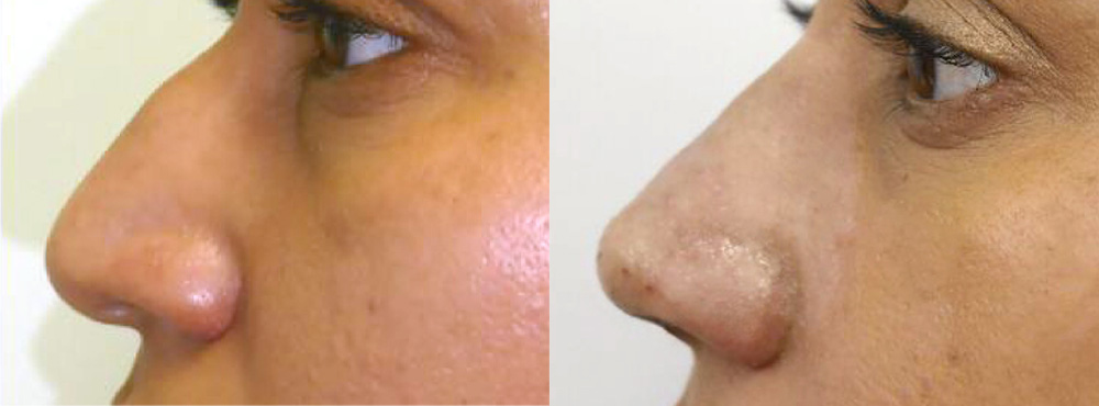 Rhinoplasty in Miami Before And After