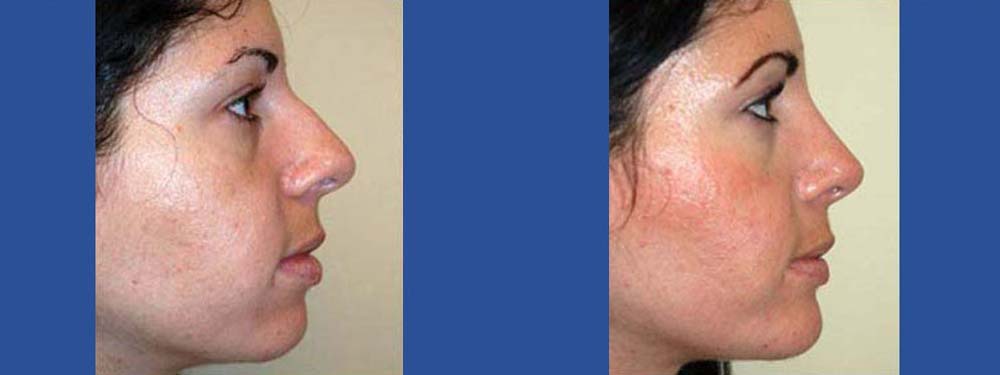 Rhinoplasty before and after