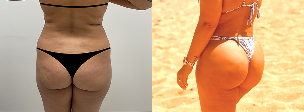 Butt Lift Before and After