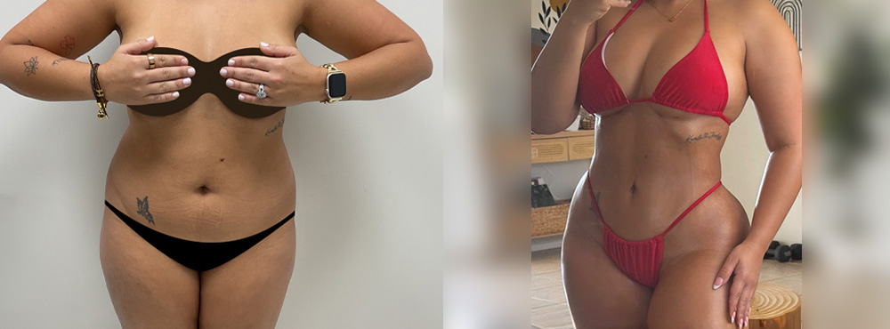 Butt Lift Before and After