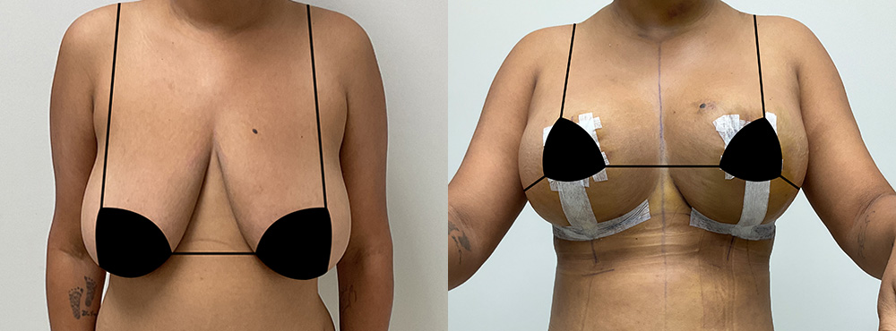 Breast Reduction Before and After