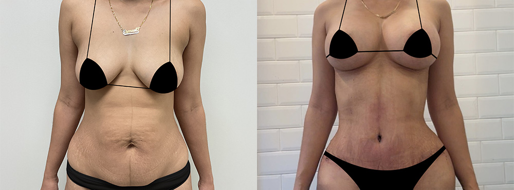 Mommy Makeover Before and After