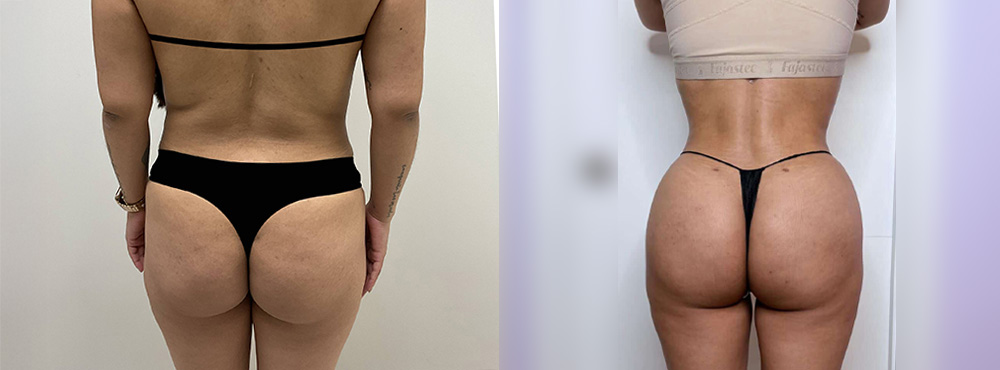 BBL Before and After in miami