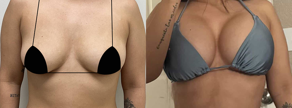 Breast Augmentation before and after
